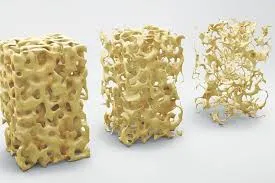 Tratamento para Osteoporose em sSP Imagem